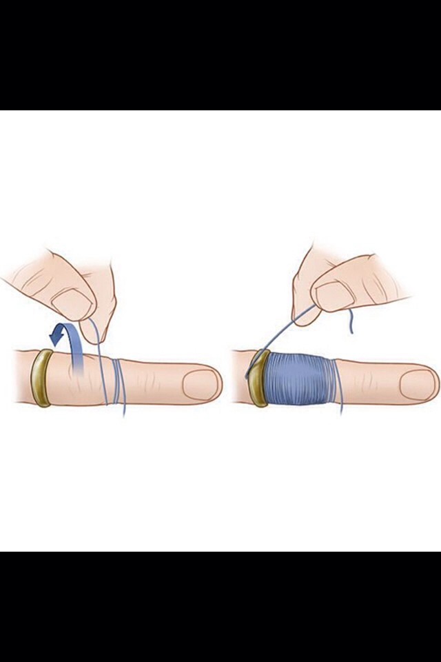 How To Take A Ring Off A Swollen Finger Without Cutting It Trusper