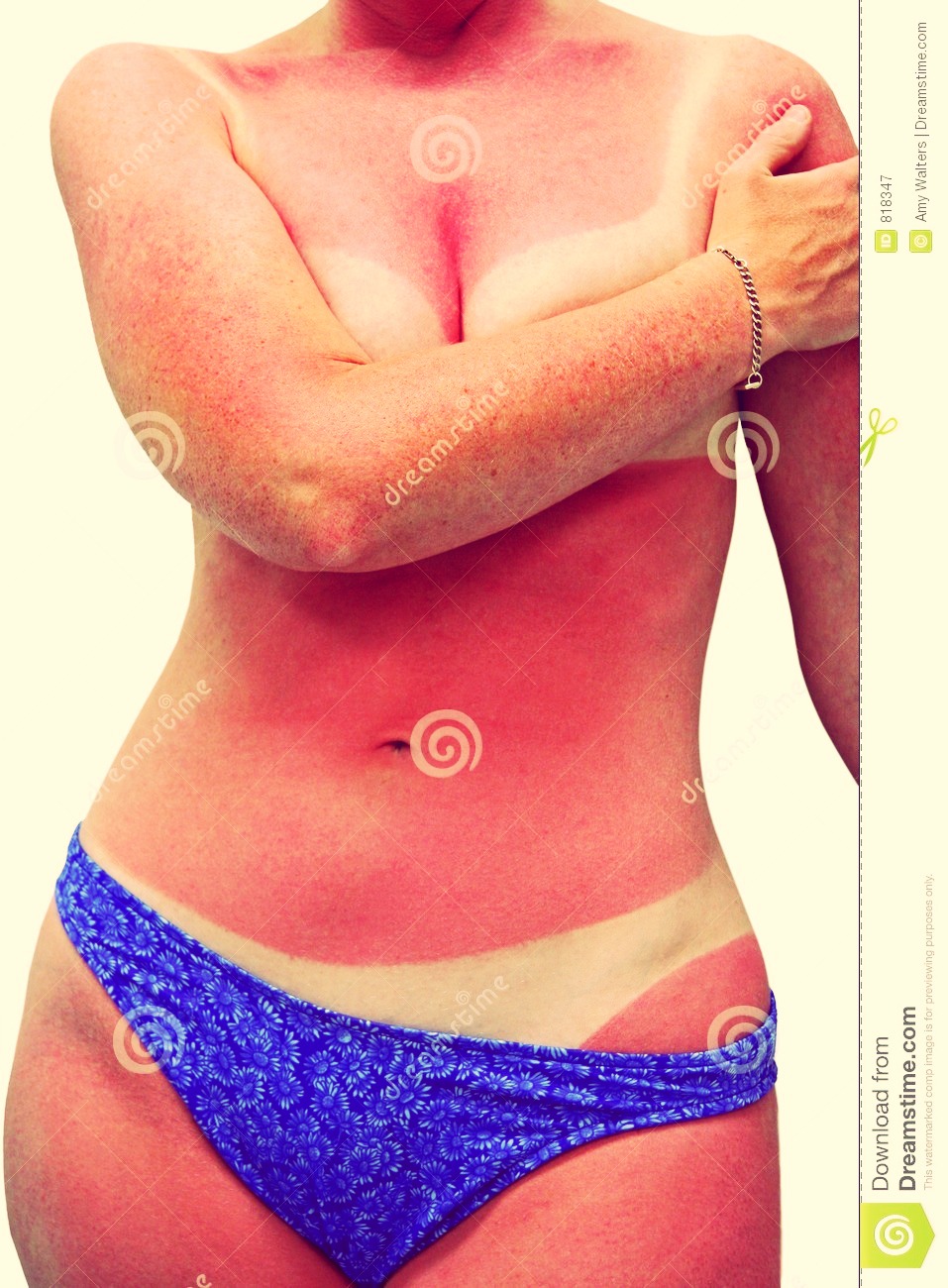 will a sunburn turn into a tan