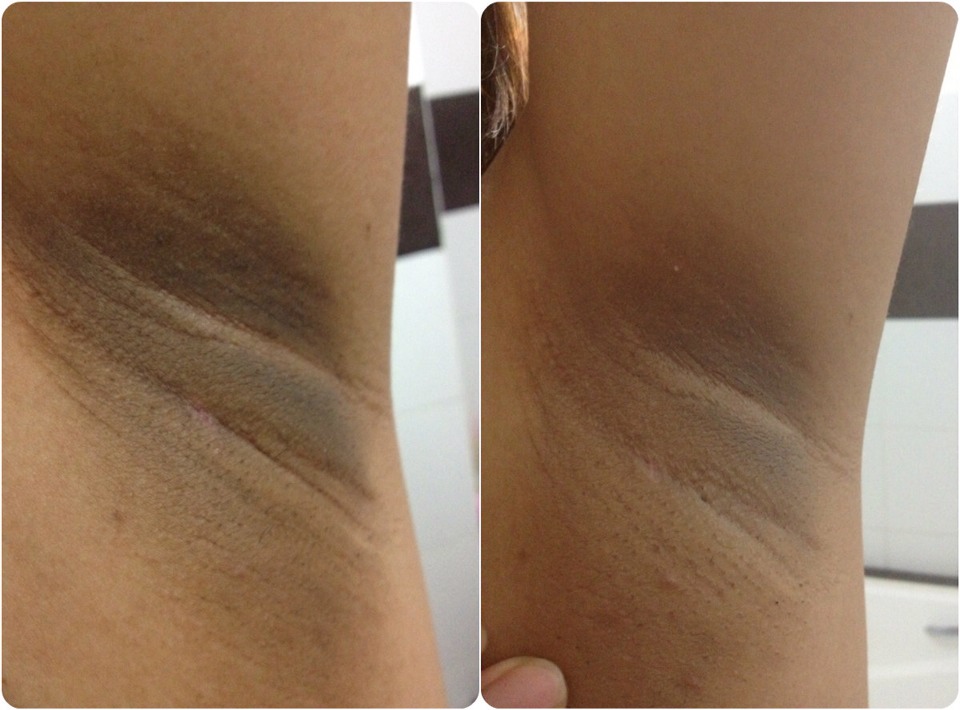 waxing or electrolysis the biggest reason for dark underarms is 