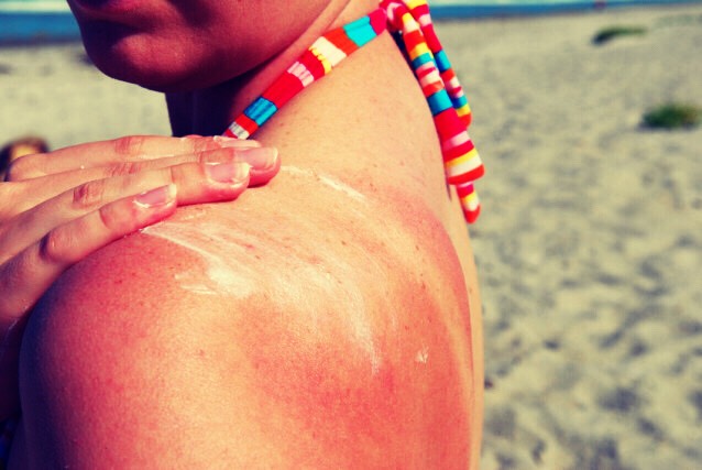 How To Get Rid Of Sunburn 5 Easy Steps To Get Rid Of Sunburn | Apps 