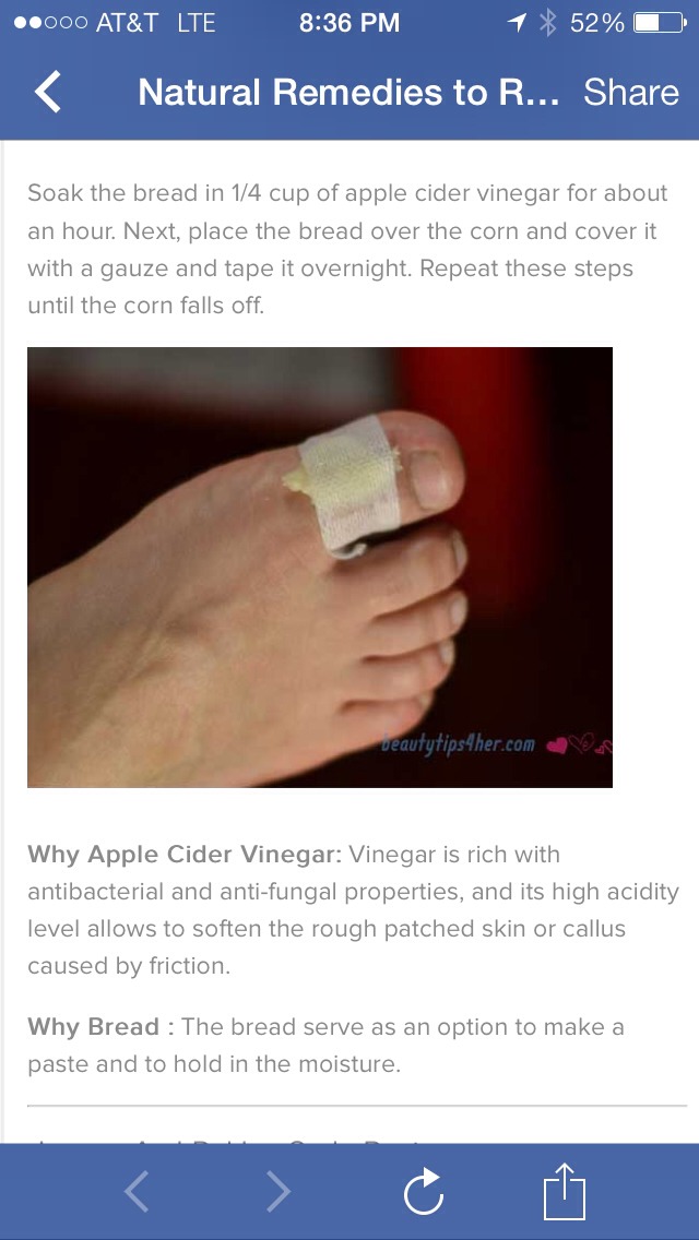 Natural Remedies to Remove Corn and Calluses This Really Works Trusper