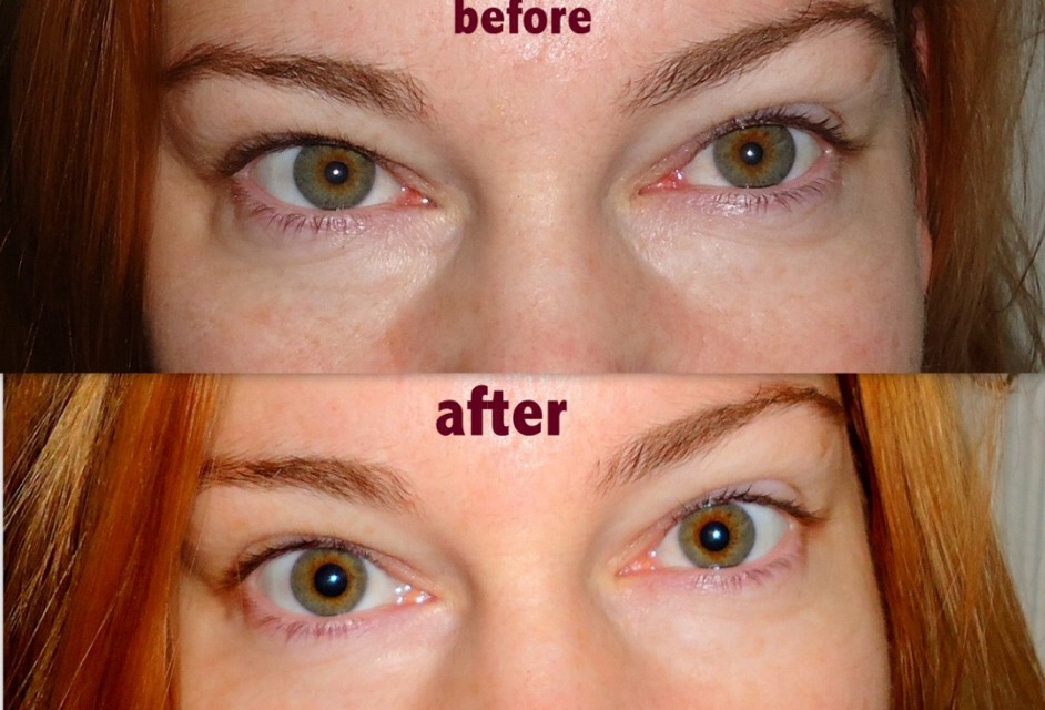 Hide Your Eye Bag, Black Eye, Or Hickey (or Zits) Completely Trusper