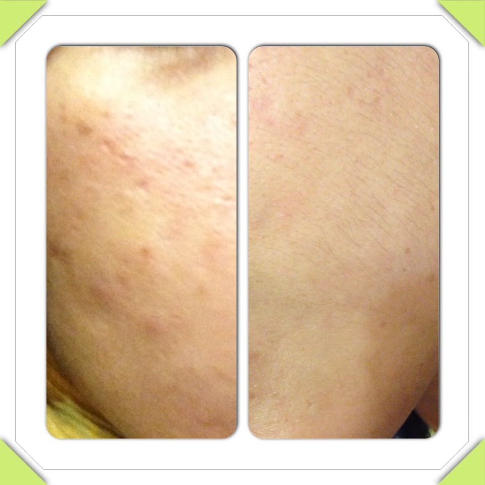 Best Acne Treatment At Home Trusper