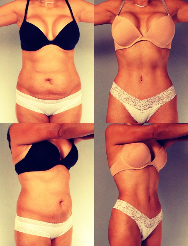 Diy Weight Loss Stomach Wrap UrbanDine